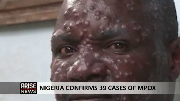 Mpox Cases In Nigeria