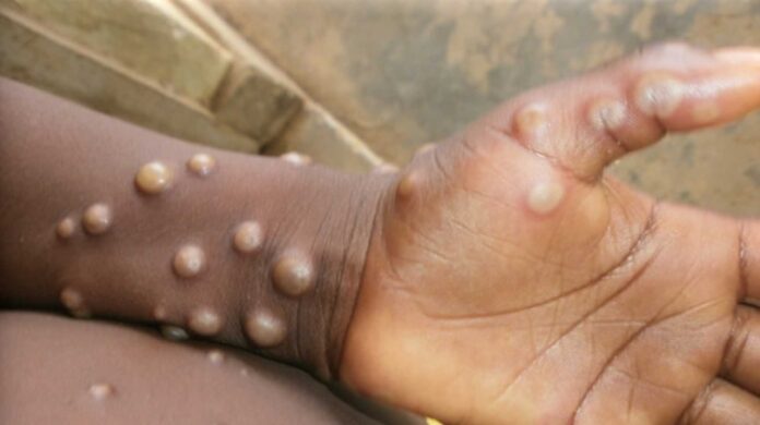 Mpox Outbreak In Akwa Ibom State