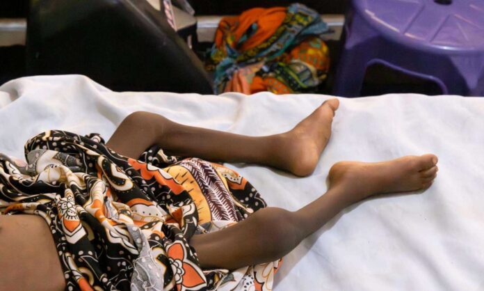 Severe Malnutrition In Northern Nigeria