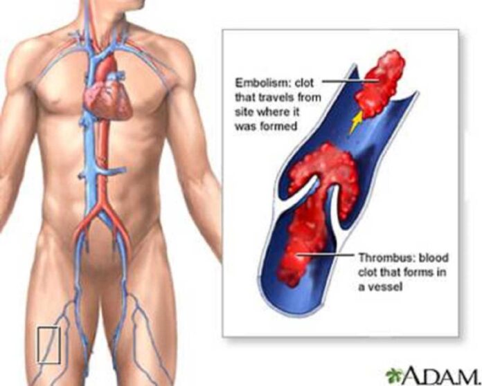 Thrombosis Awareness In Nigeria