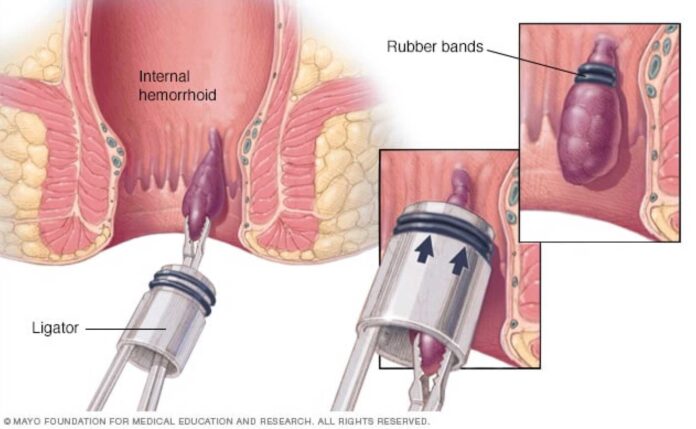 Hemorrhoid Treatment And Recovery