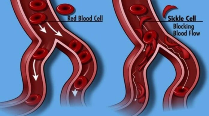 Sickle Cell Anaemia In Children