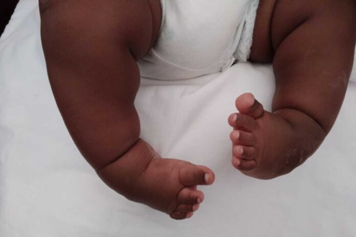 Children Clubfoot Treatment