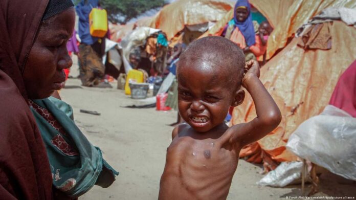 Malnutrition In Nasarawa State