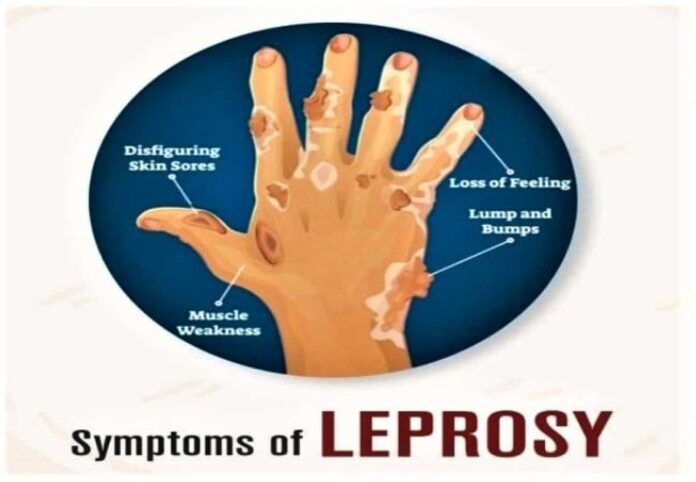 Multidrug Therapy For Leprosy