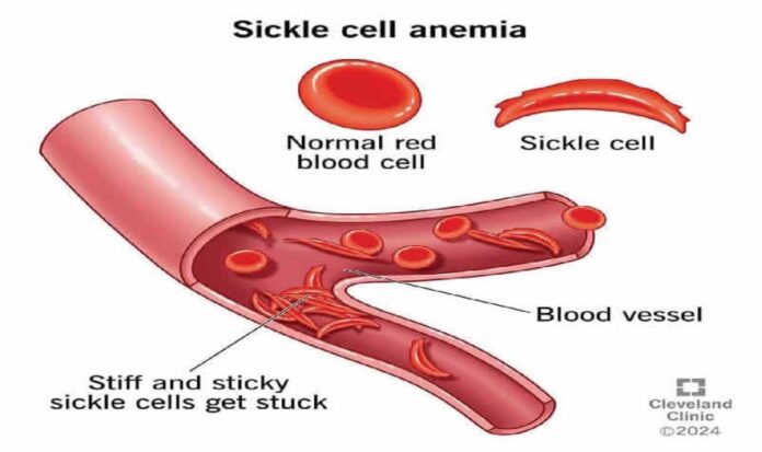 Sickle Cell Warrior